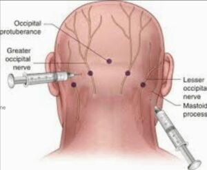 Nerve Block Injection