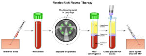 PRP-Process