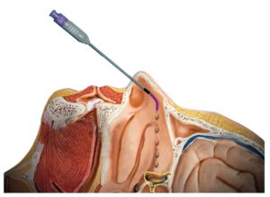 Sphenopalatine Ganglion Block