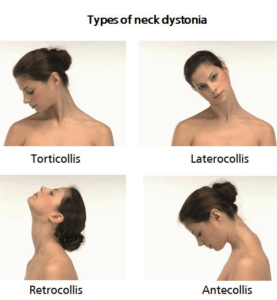 Cervical Dystonia Types