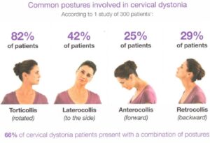 Cervical Dystonia